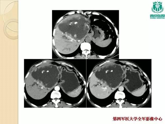 【病例】肝包虫病1例CT影像表现