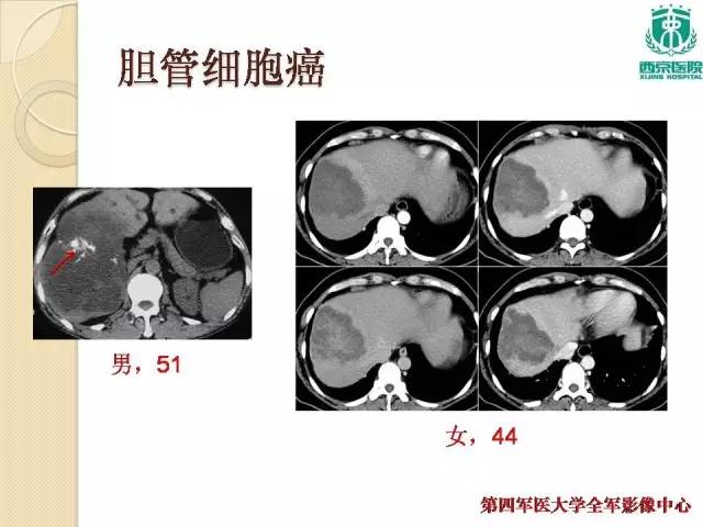 【病例】肝包虫病1例CT影像表现