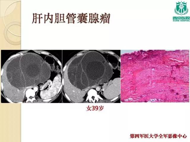 【病例】肝包虫病1例CT影像表现