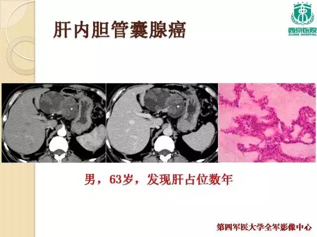 【病例】肝包虫病1例CT影像表现