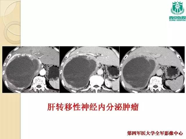 【病例】肝包虫病1例CT影像表现