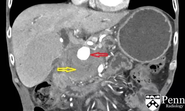 【病例】继发于慢性胰腺炎的胰背动脉假性动脉瘤1例CT 【病例】继发于慢性胰腺炎的胰背动脉假性动脉瘤1例CT