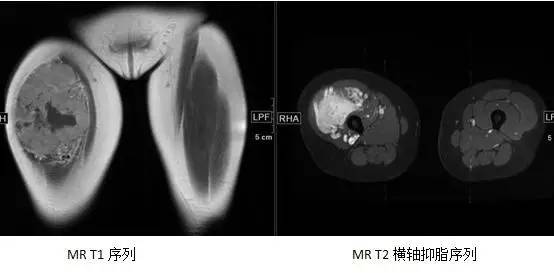 【病例】腺泡状软组织肉瘤1例MR影像表现 【病例】腺泡状软组织肉瘤1例MR影像表现