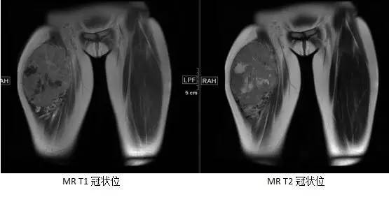 【病例】腺泡状软组织肉瘤1例MR影像表现