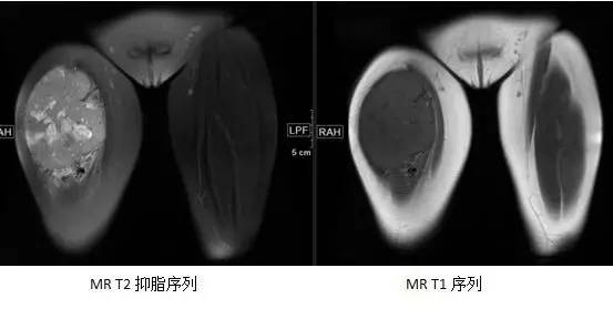 【病例】腺泡状软组织肉瘤1例MR影像表现 【病例】腺泡状软组织肉瘤1例MR影像表现