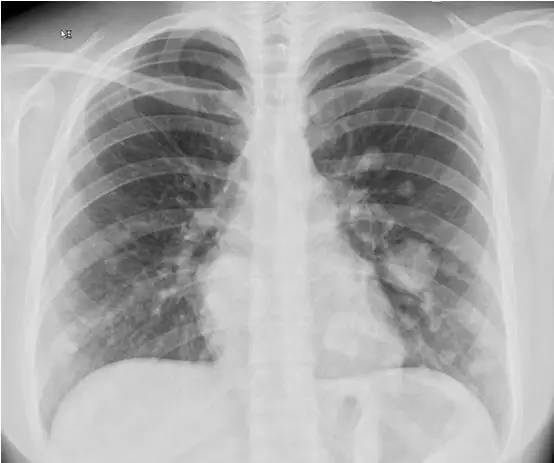 【病例】腺泡状软组织肉瘤1例MR影像表现 【病例】腺泡状软组织肉瘤1例MR影像表现