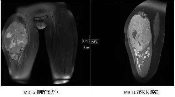 【病例】腺泡状软组织肉瘤1例MR影像表现 【病例】腺泡状软组织肉瘤1例MR影像表现
