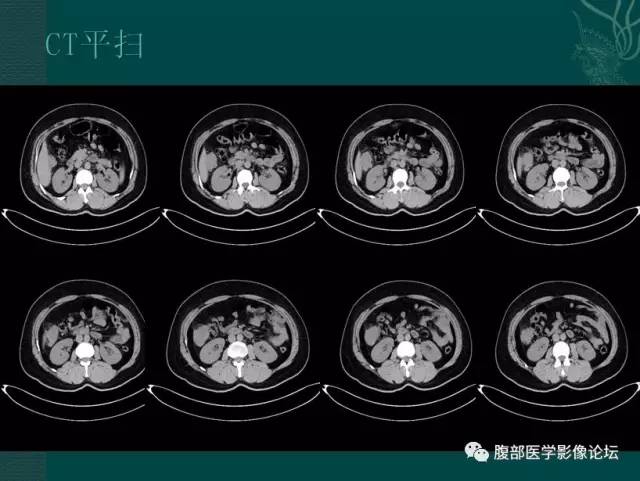 【病例】恶性腹膜间皮瘤1例CT影像表现 【病例】恶性腹膜间皮瘤1例CT影像表现