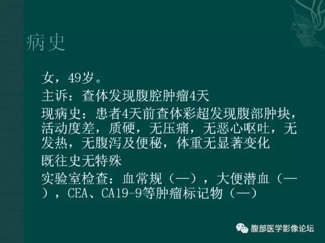 【病例】恶性腹膜间皮瘤1例CT影像表现
