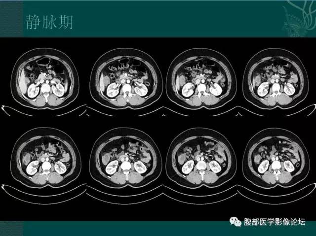 【病例】恶性腹膜间皮瘤1例CT影像表现 【病例】恶性腹膜间皮瘤1例CT影像表现