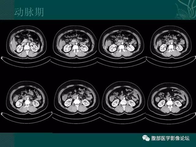 【病例】恶性腹膜间皮瘤1例CT影像表现 【病例】恶性腹膜间皮瘤1例CT影像表现