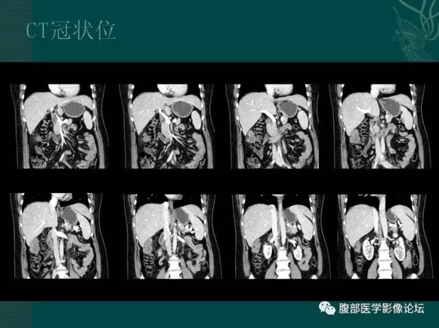 【病例】恶性腹膜间皮瘤1例CT影像表现 【病例】恶性腹膜间皮瘤1例CT影像表现