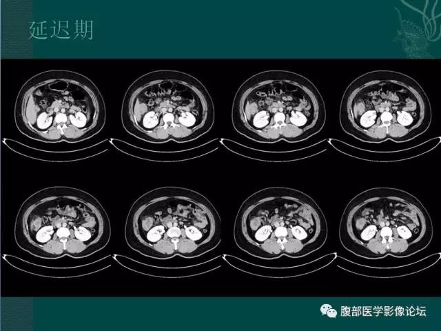 【病例】恶性腹膜间皮瘤1例CT影像表现 【病例】恶性腹膜间皮瘤1例CT影像表现