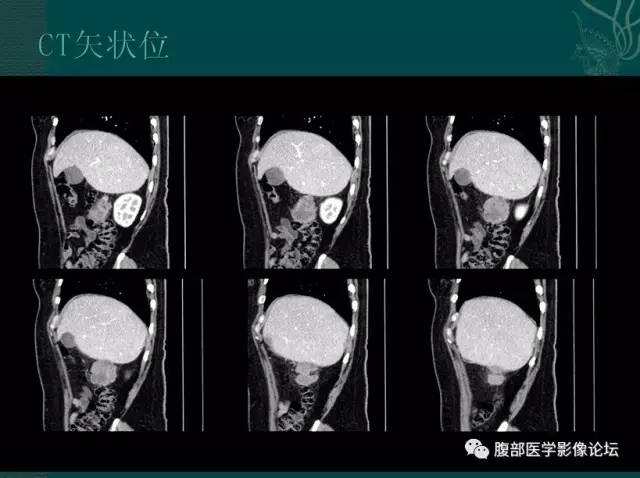 【病例】恶性腹膜间皮瘤1例CT影像表现 【病例】恶性腹膜间皮瘤1例CT影像表现