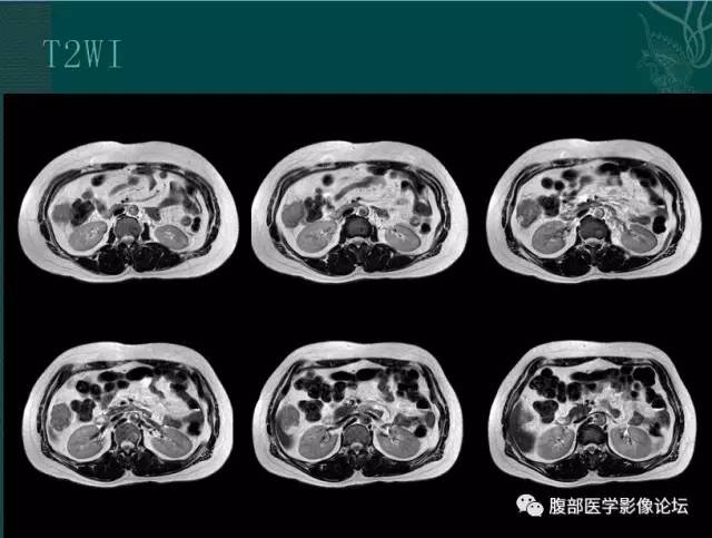 【病例】恶性腹膜间皮瘤1例CT影像表现 【病例】恶性腹膜间皮瘤1例CT影像表现
