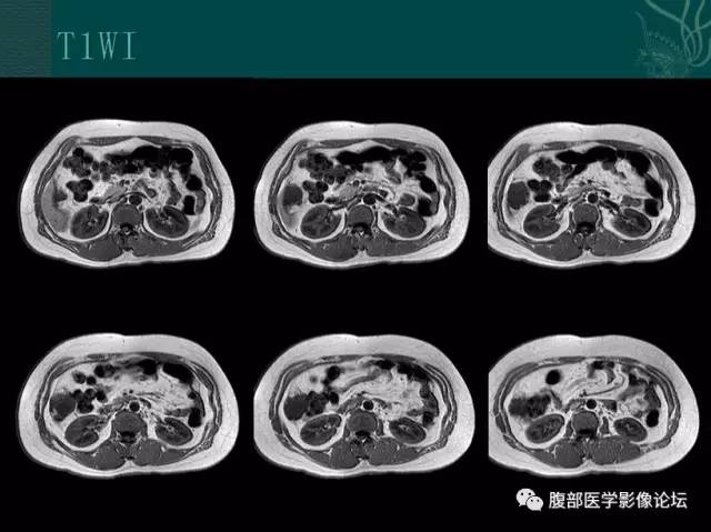【病例】恶性腹膜间皮瘤1例CT影像表现 【病例】恶性腹膜间皮瘤1例CT影像表现