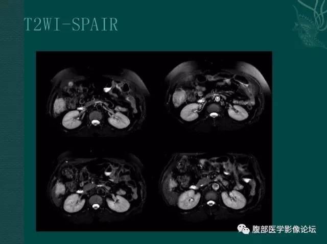【病例】恶性腹膜间皮瘤1例CT影像表现 【病例】恶性腹膜间皮瘤1例CT影像表现