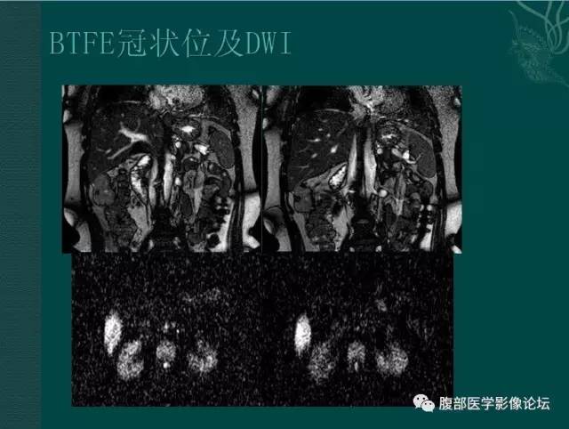 【病例】恶性腹膜间皮瘤1例CT影像表现 【病例】恶性腹膜间皮瘤1例CT影像表现