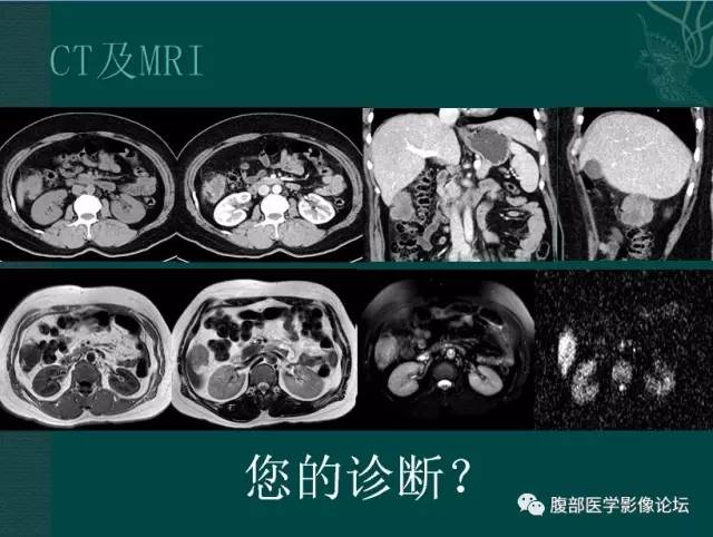 【病例】恶性腹膜间皮瘤1例CT影像表现 【病例】恶性腹膜间皮瘤1例CT影像表现
