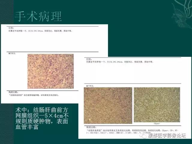 【病例】恶性腹膜间皮瘤1例CT影像表现 【病例】恶性腹膜间皮瘤1例CT影像表现