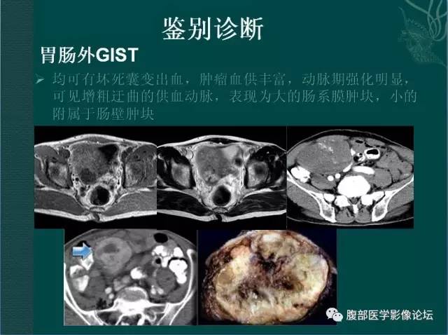 【病例】恶性腹膜间皮瘤1例CT影像表现 【病例】恶性腹膜间皮瘤1例CT影像表现