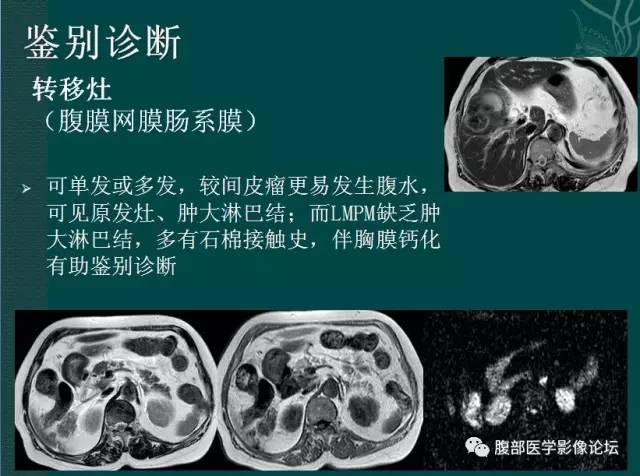 【病例】恶性腹膜间皮瘤1例CT影像表现 【病例】恶性腹膜间皮瘤1例CT影像表现