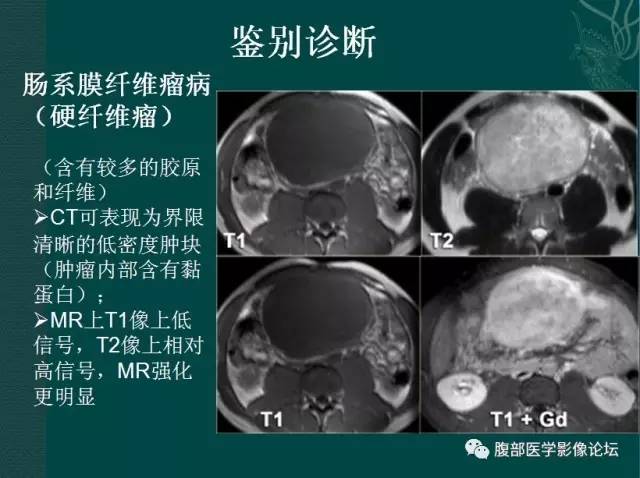 【病例】恶性腹膜间皮瘤1例CT影像表现 【病例】恶性腹膜间皮瘤1例CT影像表现
