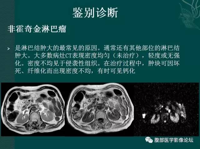 【病例】恶性腹膜间皮瘤1例CT影像表现 【病例】恶性腹膜间皮瘤1例CT影像表现