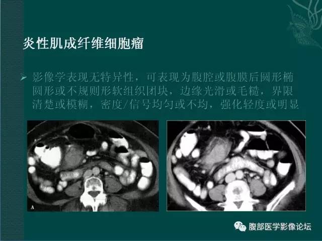 【病例】恶性腹膜间皮瘤1例CT影像表现 【病例】恶性腹膜间皮瘤1例CT影像表现