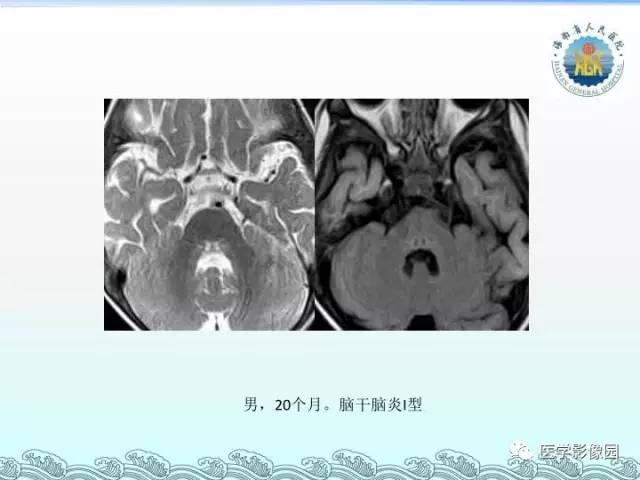 【PPT】EV71型感染手足口病合并中枢损害的影像学诊断思路