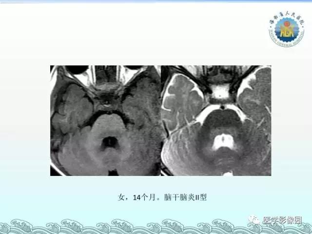 【PPT】EV71型感染手足口病合并中枢损害的影像学诊断思路