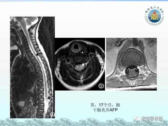 【PPT】EV71型感染手足口病合并中枢损害的影像学诊断思路