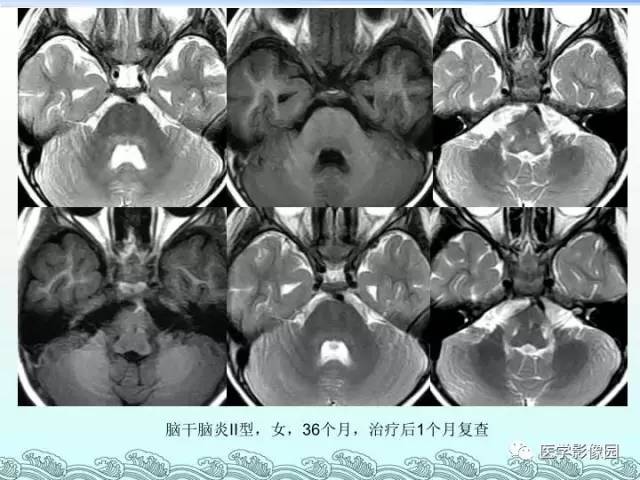 【PPT】EV71型感染手足口病合并中枢损害的影像学诊断思路