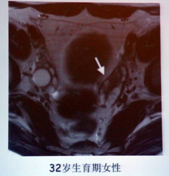 卵巢囊性病变，如何进行MR诊断？