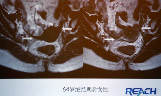 卵巢囊性病变，如何进行MR诊断？