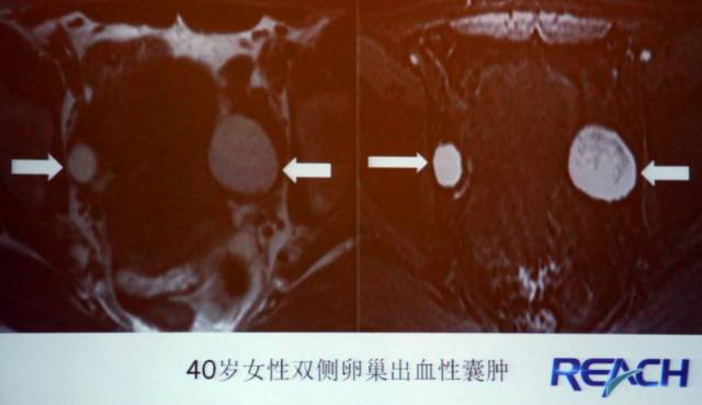 卵巢囊性病变,如何进行MR诊断? 卵巢囊性病变,如何进行MR诊断?