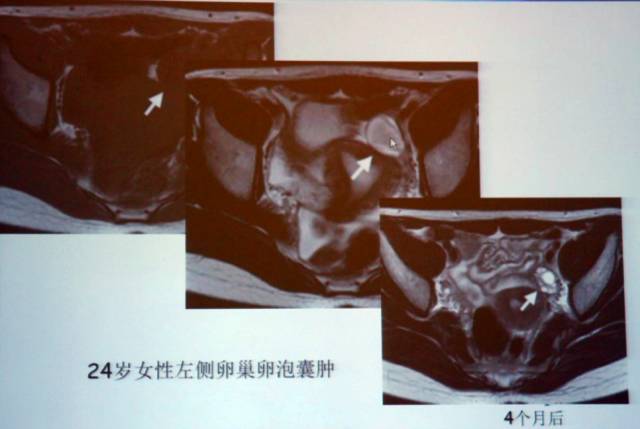 卵巢囊性病变,如何进行MR诊断? 卵巢囊性病变,如何进行MR诊断?