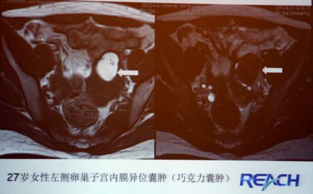 卵巢囊性病变,如何进行MR诊断? 卵巢囊性病变,如何进行MR诊断?