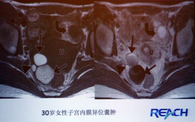 卵巢囊性病变,如何进行MR诊断? 卵巢囊性病变,如何进行MR诊断?