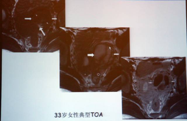 卵巢囊性病变,如何进行MR诊断? 卵巢囊性病变,如何进行MR诊断?