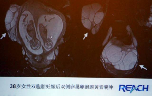 卵巢囊性病变,如何进行MR诊断? 卵巢囊性病变,如何进行MR诊断?