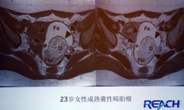卵巢囊性病变,如何进行MR诊断? 卵巢囊性病变,如何进行MR诊断?