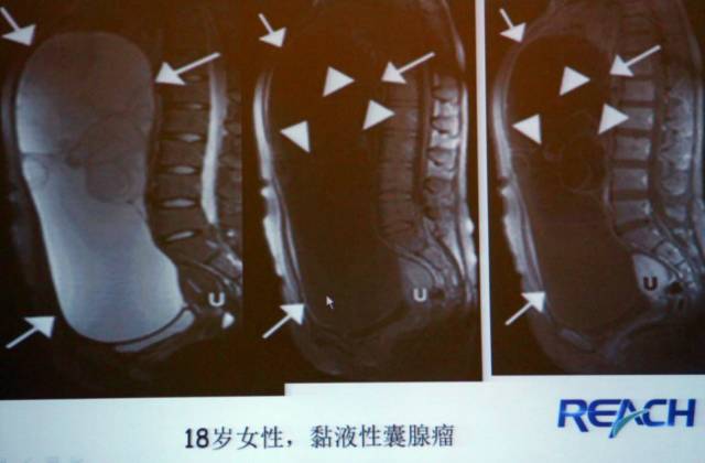 卵巢囊性病变,如何进行MR诊断? 卵巢囊性病变,如何进行MR诊断?