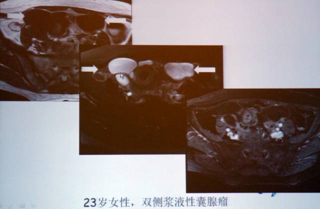 卵巢囊性病变,如何进行MR诊断? 卵巢囊性病变,如何进行MR诊断?