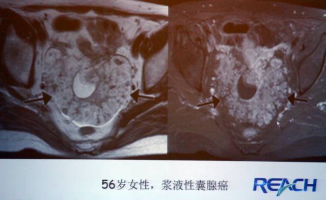 卵巢囊性病变,如何进行MR诊断? 卵巢囊性病变,如何进行MR诊断?