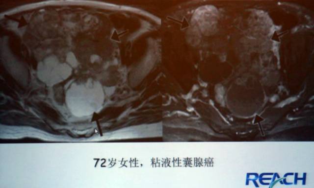 卵巢囊性病变,如何进行MR诊断? 卵巢囊性病变,如何进行MR诊断?