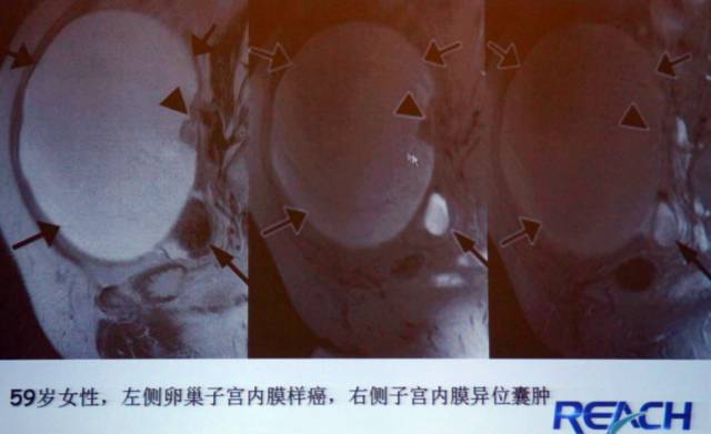 卵巢囊性病变,如何进行MR诊断? 卵巢囊性病变,如何进行MR诊断?