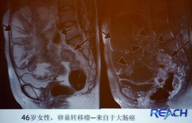 卵巢囊性病变,如何进行MR诊断? 卵巢囊性病变,如何进行MR诊断?