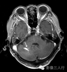 "水母头征"，这个征象提示啥？