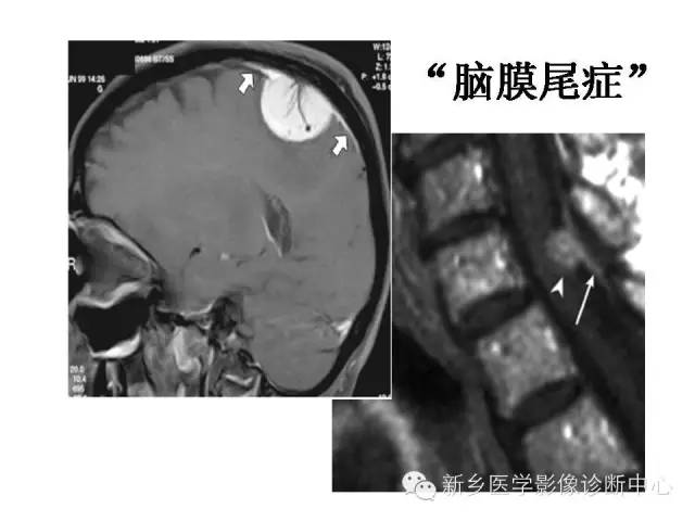【PPT】可以引起脑膜强化的病例赏析